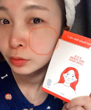 자이엘 S.O.S 레드 칙 케어팩 2 Box — 5점을 준 리뷰어가 2020년 4월 올린 사용 사진