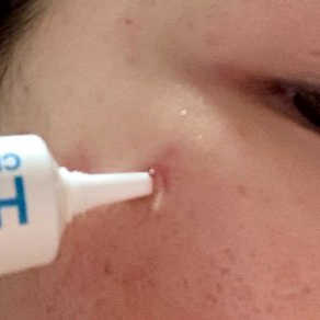 히루스카 포스트아크네 클리어 — 5점을 준 리뷰어가 2020년 12월 올린 사용 사진