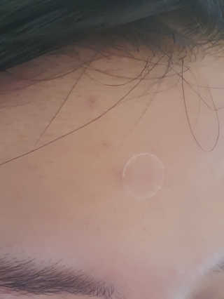 엘라밴드 하이드로 도트 스팟패치 12mm, 10mm — 4점을 준 리뷰어가 2020년 8월 올린 사용 사진