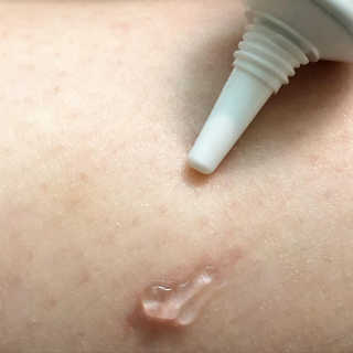 derma SC-Gel 더마에스씨 겔 20g — 5점을 준 리뷰어가 2020년 4월 올린 사용 사진