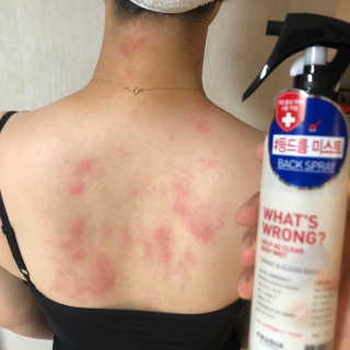 [후르디아] 등드름 잡는 바디 미스트 2개 세트 — 5점을 준 리뷰어가 2020년 7월 올린 사용 사진