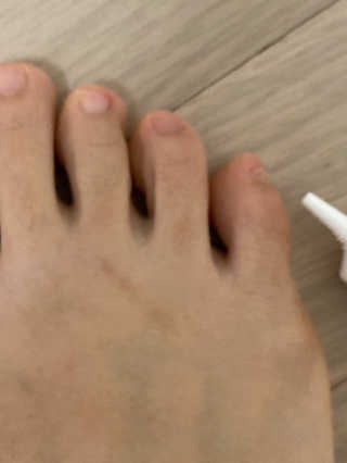 히루스카 포스트아크네 클리어 — 5점을 준 리뷰어가 2020년 12월 올린 사용 사진