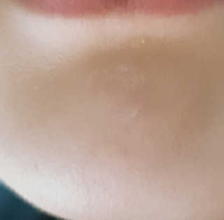 엘라밴드 하이드로 도트 스팟패치 12mm, 티트리 — 5점을 준 리뷰어가 2020년 8월 올린 사용 사진
