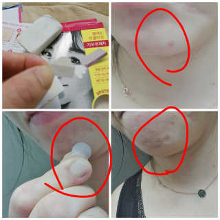 엘라밴드 하이드로 도트 스팟패치 12mm, 10mm — 5점을 준 리뷰어가 2020년 8월 올린 사용 사진