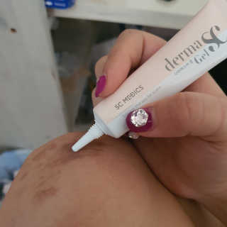 derma SC-Gel 더마에스씨 겔 20g — 5점을 준 리뷰어가 2020년 5월 올린 사용 사진