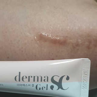 derma SC-Gel 더마에스씨 겔 20g — 5점을 준 리뷰어가 2020년 5월 올린 사용 사진