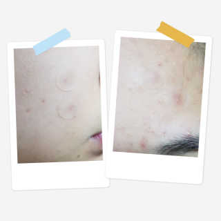 엘라밴드 하이드로 도트 스팟패치 12mm, 10mm — 5점을 준 리뷰어가 2020년 8월 올린 사용 사진