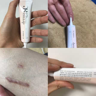 derma SC-Gel 더마에스씨 겔 20g — 5점을 준 리뷰어가 2020년 5월 올린 사용 사진
