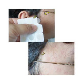 엘라밴드 하이드로 도트 스팟패치 12mm, 10mm — 5점을 준 리뷰어가 2020년 8월 올린 사용 사진