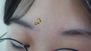 엘라밴드 하이드로 도트 스팟패치 12mm, 10mm, 티트리 — 5점을 준 리뷰어가 2020년 9월 올린 사용 사진