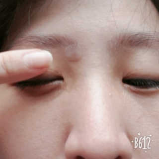 엘라밴드 하이드로 도트 스팟패치 12mm, 10mm — 5점을 준 리뷰어가 2020년 9월 올린 사용 사진