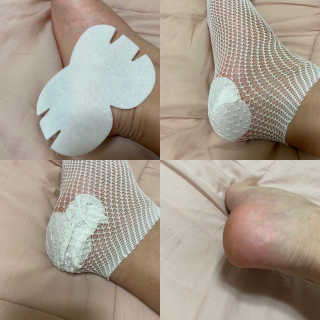 라보타치 베노라이트 + 풋 모이스트 패치 — 3점을 준 리뷰어가 2020년 10월 올린 사용 사진