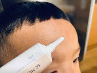 derma SC-Gel 더마에스씨 겔 20g — 5점을 준 리뷰어가 2020년 4월 올린 사용 사진