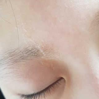 derma SC-Gel 더마에스씨 겔 20g — 5점을 준 리뷰어가 2020년 5월 올린 사용 사진