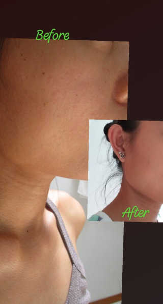 뷰트리 BEAUTREE PLA 버블 각질 제거 클렌징 패드 — 5점을 준 리뷰어가 2020년 8월 올린 사용 사진