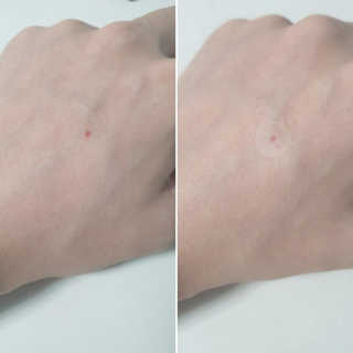 엘라밴드 하이드로 도트 스팟패치 12mm, 10mm, 티트리 — 5점을 준 리뷰어가 2020년 9월 올린 사용 사진
