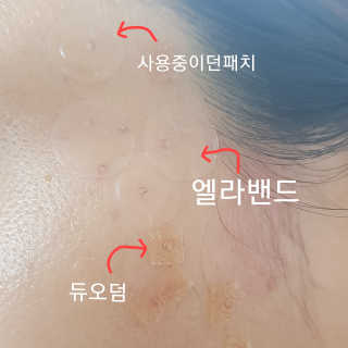 엘라밴드 하이드로 도트 스팟패치 12mm, 티트리 — 4점을 준 리뷰어가 2020년 8월 올린 사용 사진