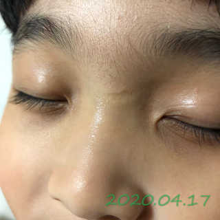 derma SC-Gel 더마에스씨 겔 20g — 4.5점을 준 리뷰어가 2020년 4월 올린 사용 사진